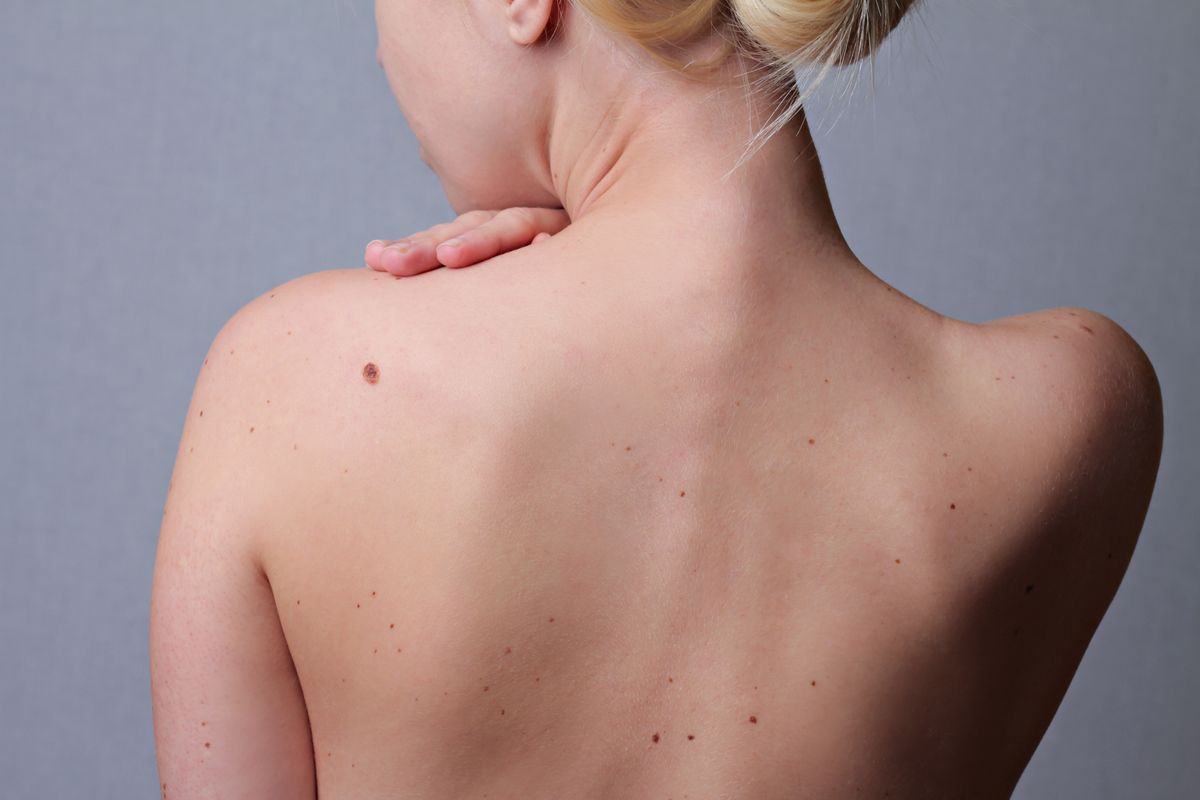 Signs of Basal Cell Carcinoma, According to Doctors - Including Skin Spots