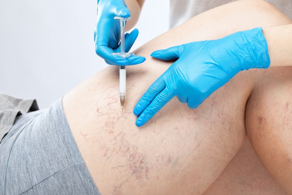 Viva Varicose: Understanding the Highs and Lows of Vein Health